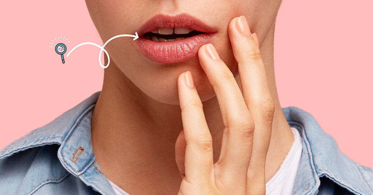 Болевые точки: почему появляются язвы во рту и как их лечить