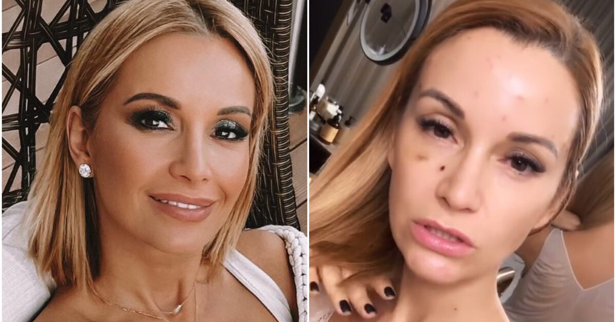Ольга Орлова показала лицо в синяках после косметологической процедуры
