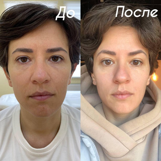 Как сильно меняет лицо женщины блефаропластика: фото до и после